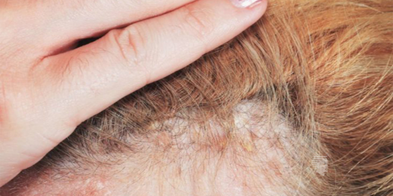 Can a Burning Scalp Lead to Hair Loss? -UAE