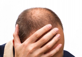 baldness treatment 