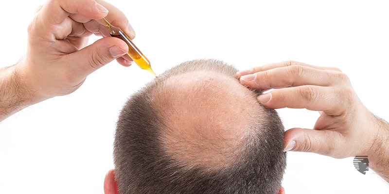 What Are the Home Remedies to Prevent Hair Fall