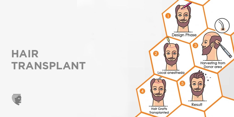 Ultimate Guide for Hair Transplant! Cost, Procedure, Pre & Post Care!