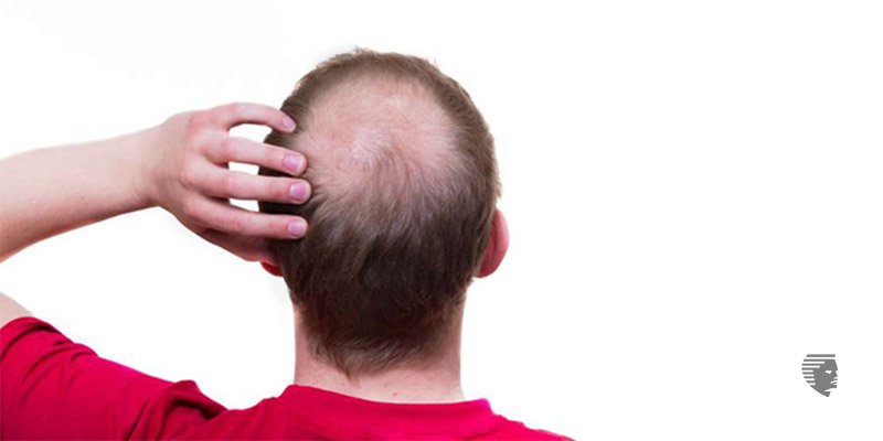 Everything You Wanted To Know About Hair Transplant