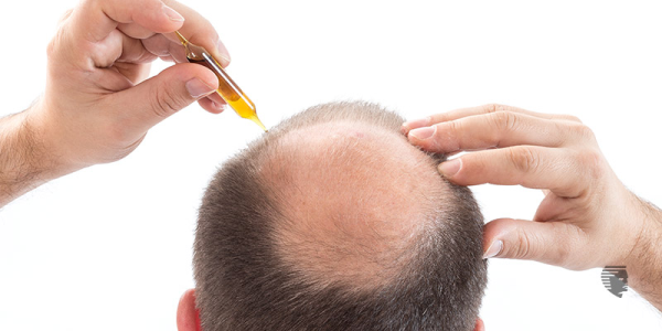 What Are the Home Remedies to Prevent Hair Fall