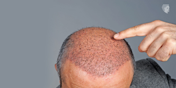 How to Undo the Damage of Bad a Hair Transplant?